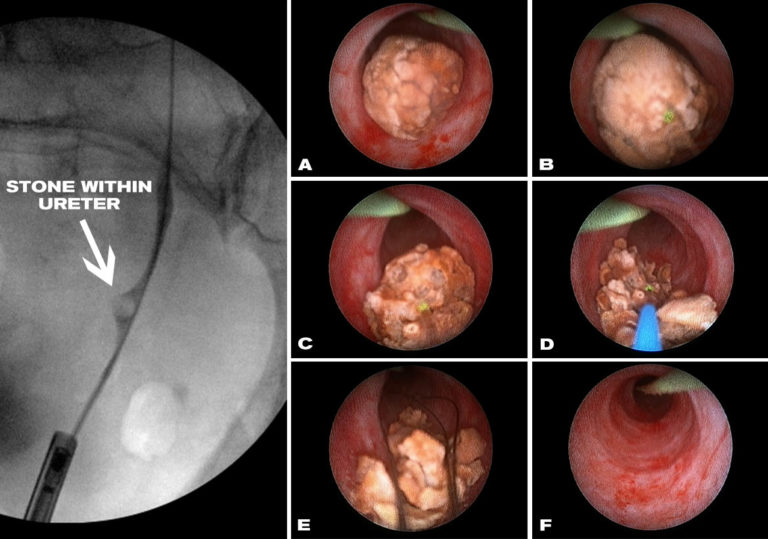 Ureteroscopy-768×539
