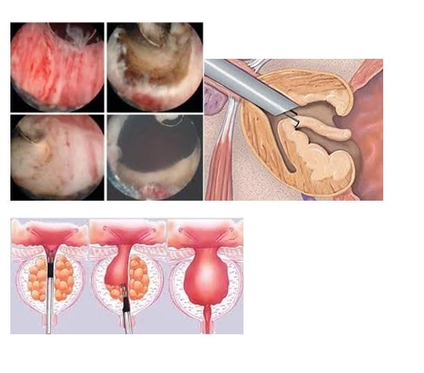 transurethral-resection-of-the-prostate-21