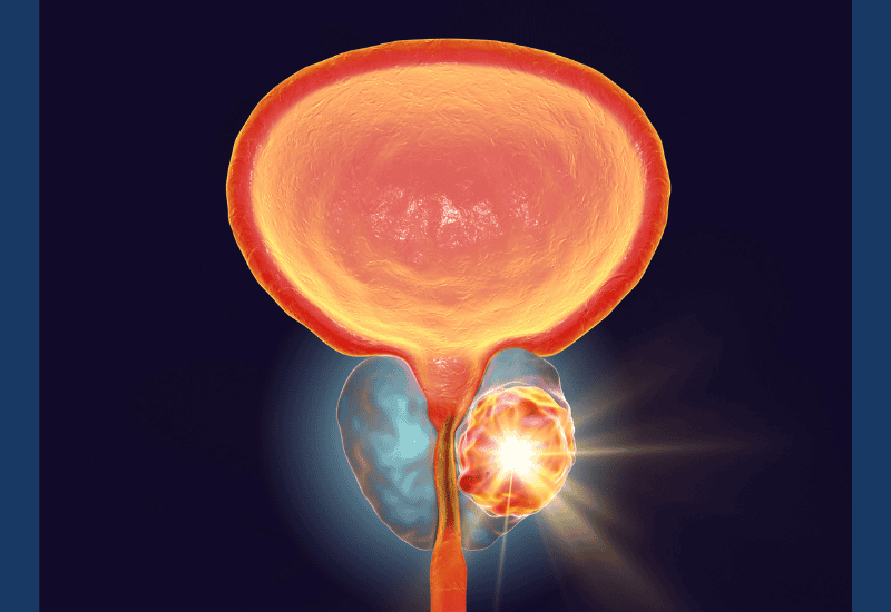 prostate cancer